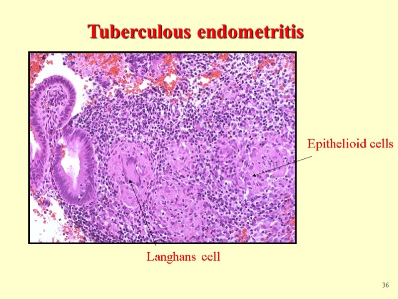 Tuberculous endometritis Epithelioid cells Langhans cell 36